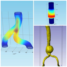 Biofluid-Structural Interaction in Abdominal Aortic Aneurysm for Predicting ...