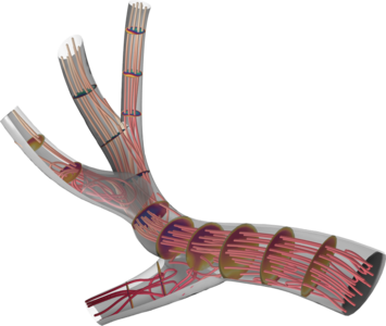 Blood Flow in a Stenosed Pulmonary Artery